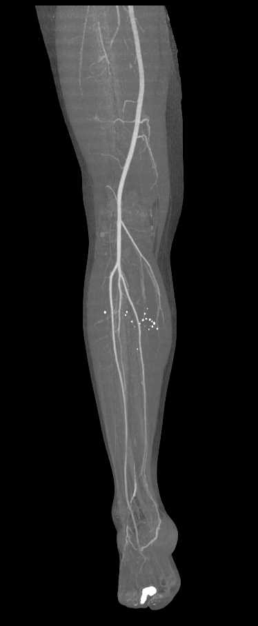 GSW Knee Without Vascular Injury with DE-CT - CTisus CT Scan