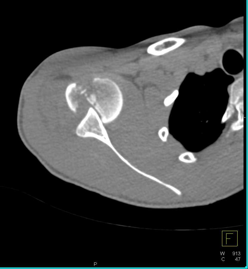 Fracture Dislocation Right Shoulder Trauma Case Studies Ctisus Ct