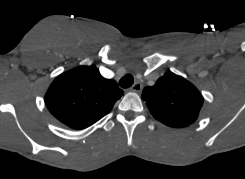 Posterior Dislocation of the Left Clavicle at Sternoclavicular Joint (SC Joint) - CTisus CT Scan