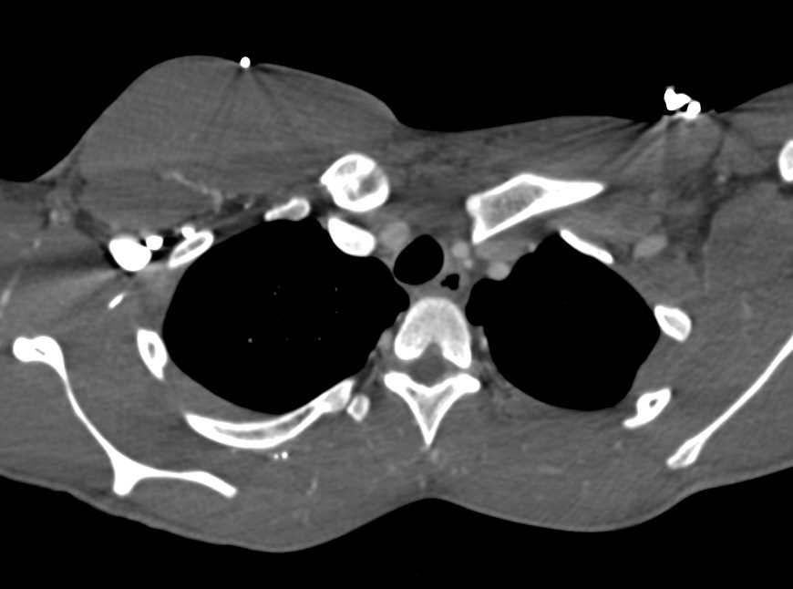 Posterior Dislocation of the Left Clavicle at Sternoclavicular Joint (SC Joint) - CTisus CT Scan