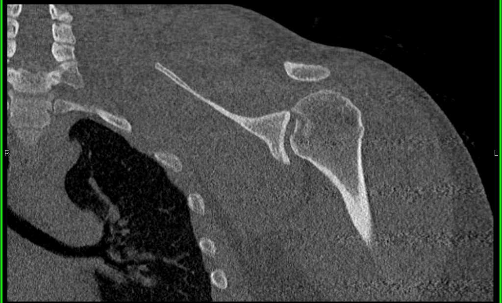 Fracture/Dislocation of Humerus and Glenoid Process - CTisus CT Scan