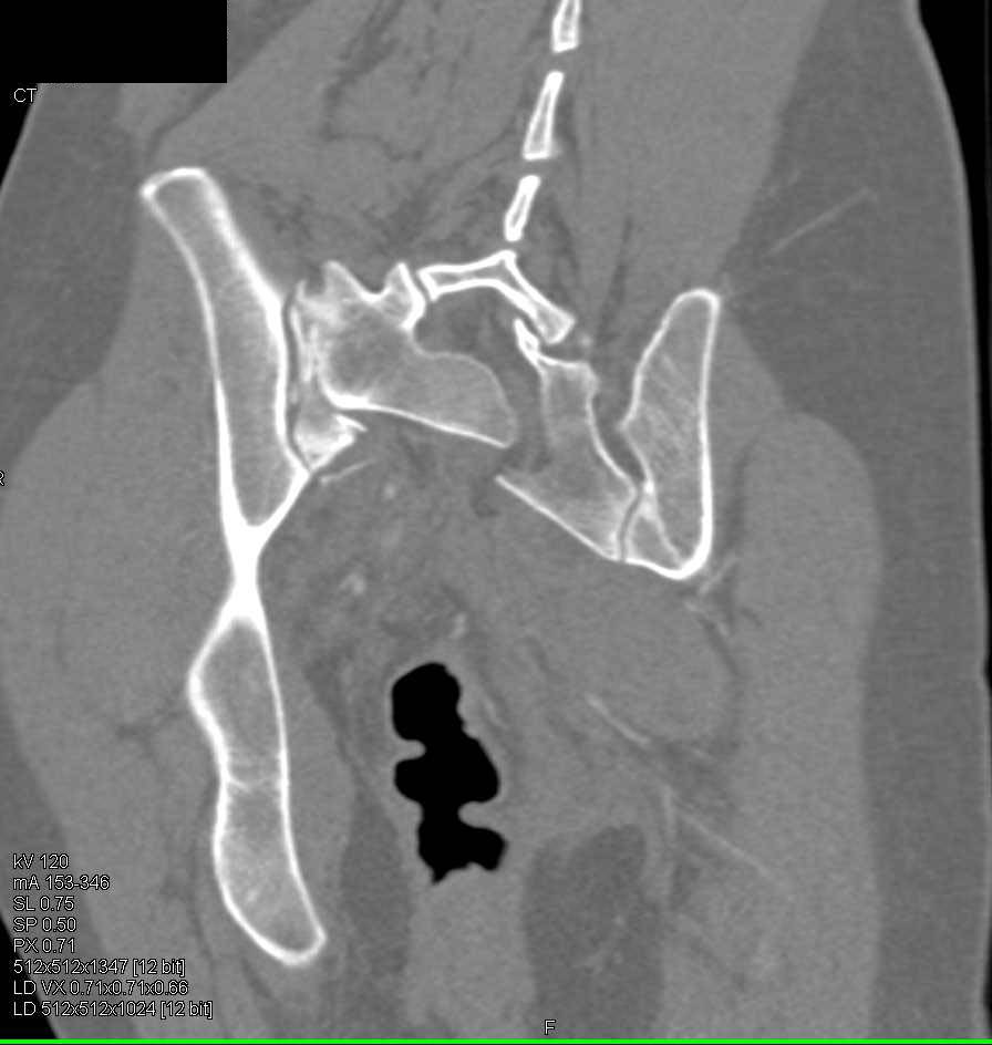 Complex Sacral Fracture with Hematoma - CTisus CT Scan