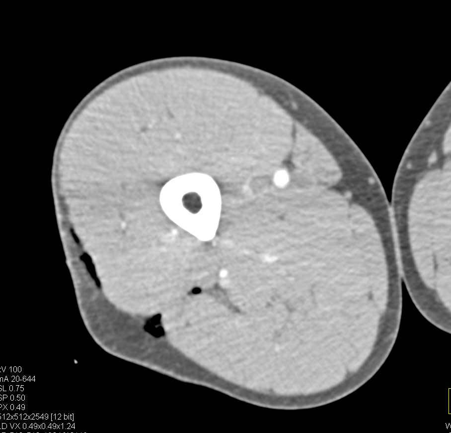 Stab Wound Thigh with Muscle Trauma - CTisus CT Scan