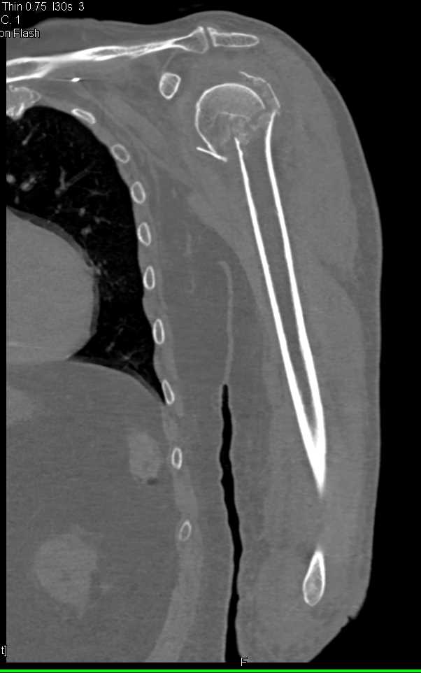 Fracture of Humerus and Glenoid - CTisus CT Scan