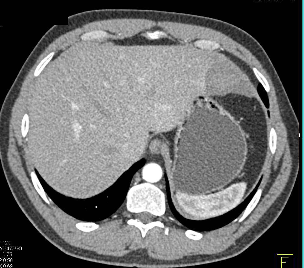 Liver Laceration and Hemoperitoneum - CTisus CT Scan