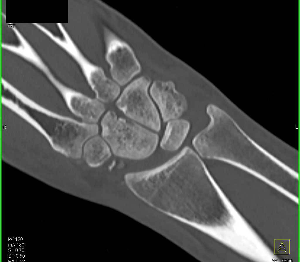 Scaphoid Fracture - CTisus CT Scan