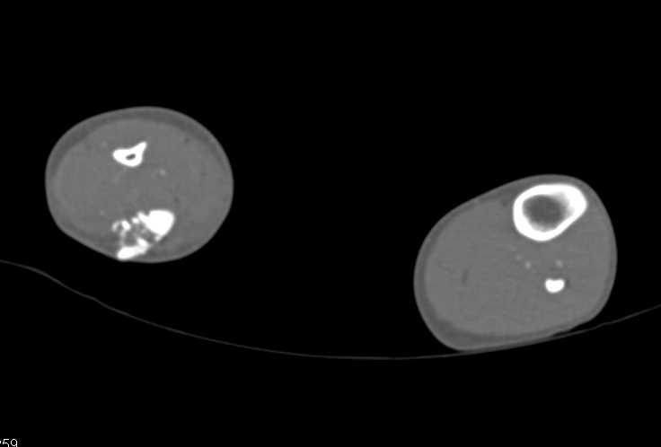 Multiple Fractures Involving Femur, Tibia and Fibula Without Vascular Injury - CTisus CT Scan