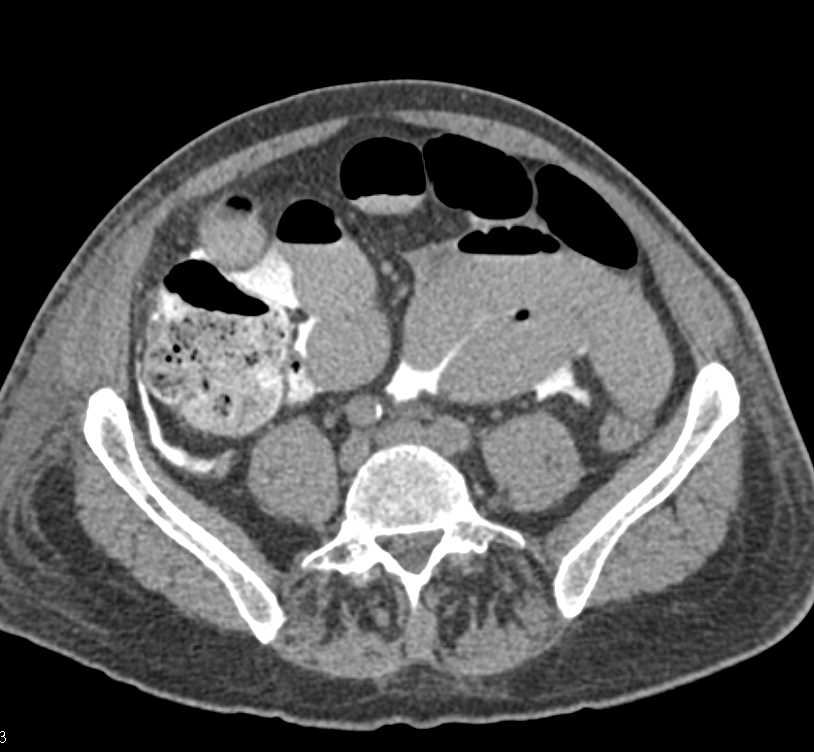 Bladder Perforation with Intraperitoneal Contrast Extravasation - CTisus CT Scan