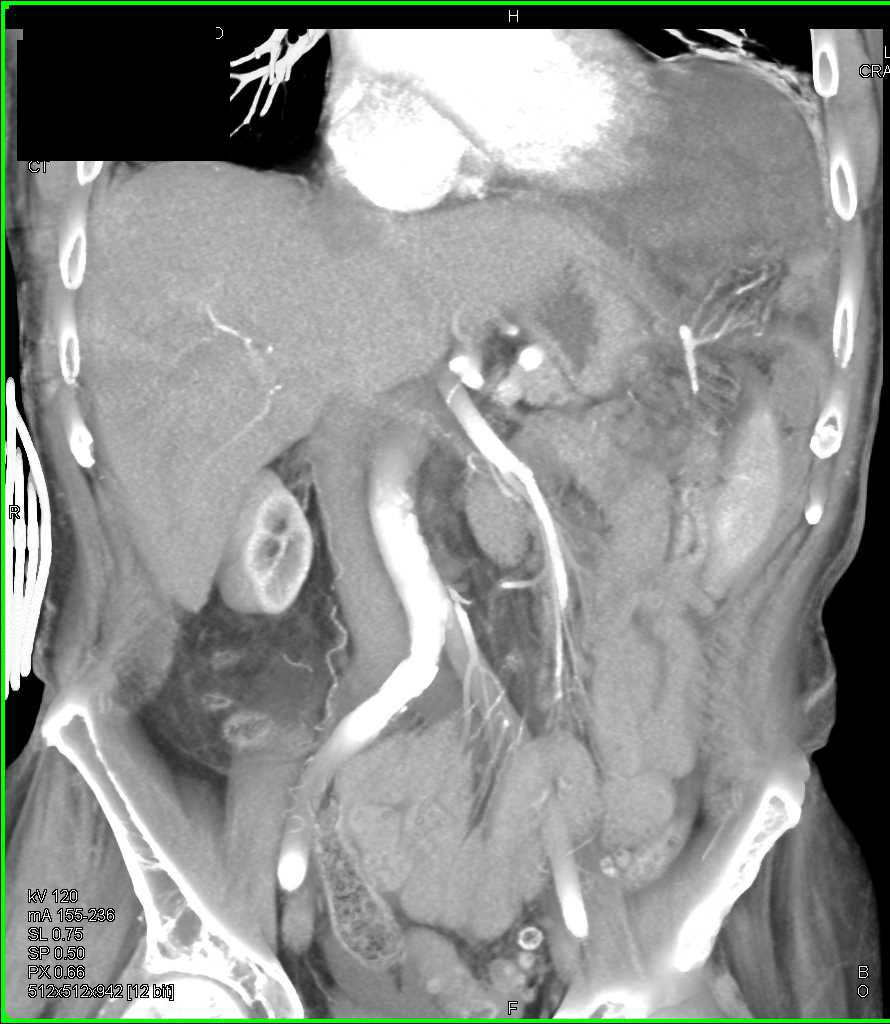 Ruptured Left Hemidiagphram - CTisus CT Scan