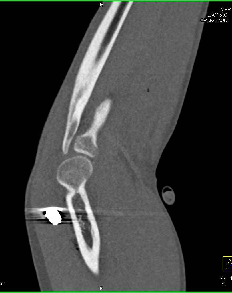 GSW to Elbow with Fracture but no Vascular Injury - CTisus CT Scan