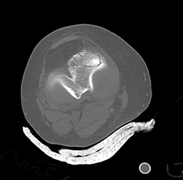 Comminuted Fracture of the Tibia and Fibula - CTisus CT Scan