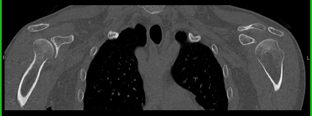 Fracture of the Left Scapula - CTisus CT Scan