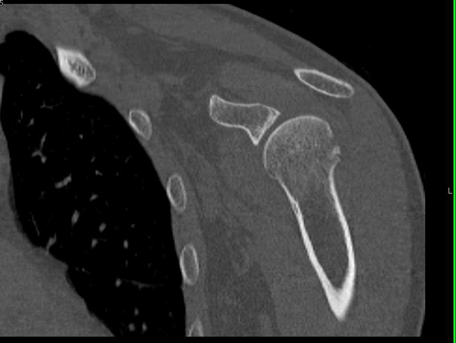 Right Scapula Fracture