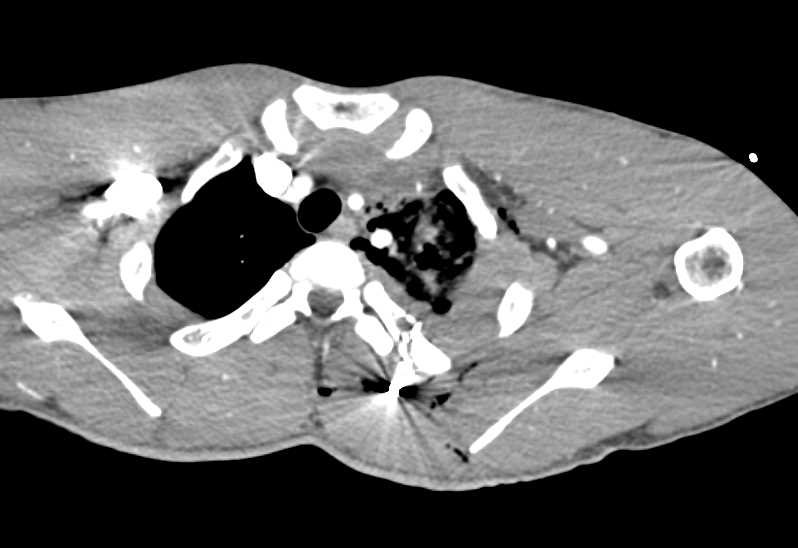 GSW with Lung, Bone and Muscle Injury - CTisus CT Scan