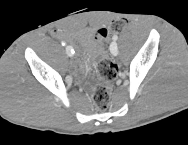 GSW Thigh Without Active Bleeding - CTisus CT Scan