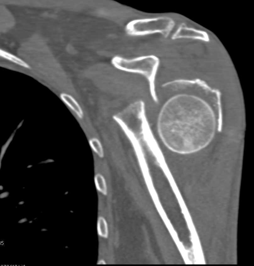 Fracture/Dislocation Left Humerus - CTisus CT Scan