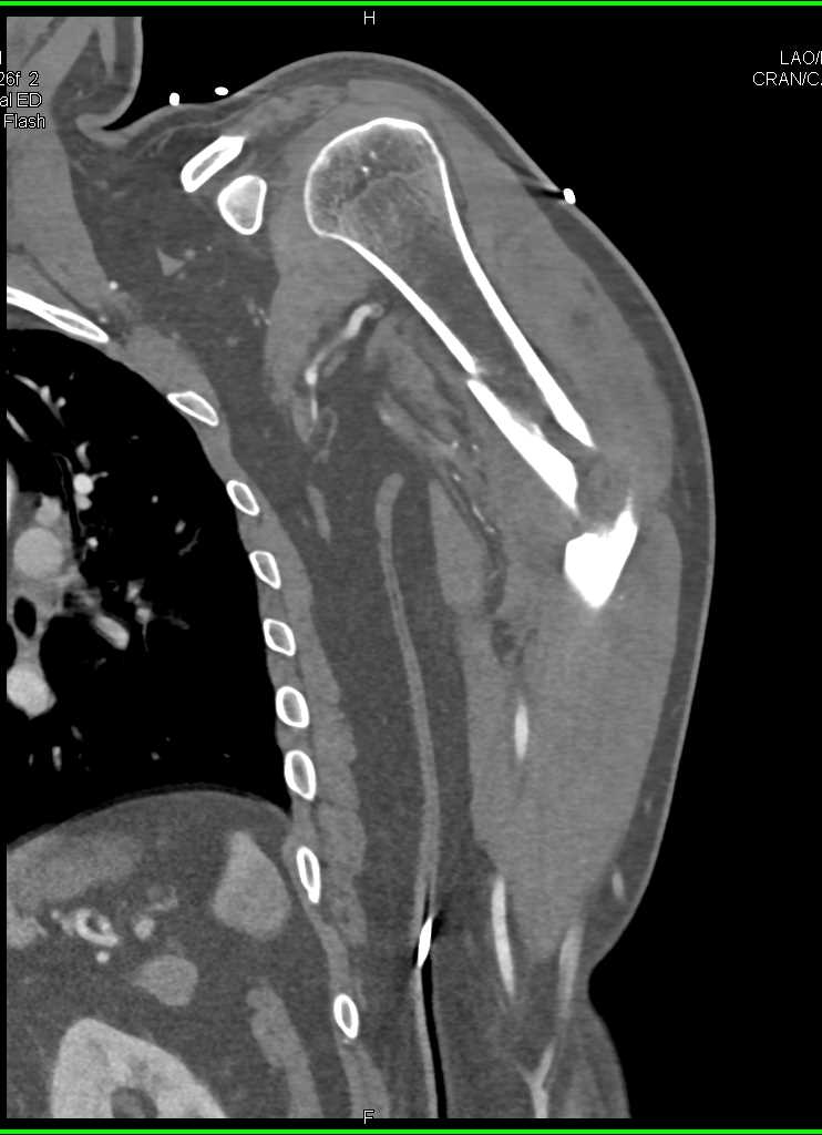 Comminuted Humerus Fracture - CTisus CT Scan