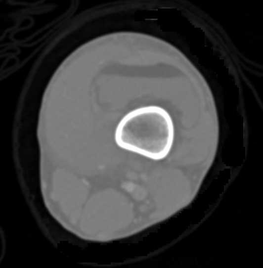 GSW Knee with Femur Fracture and Lipohemarthrosis Knee Joint - CTisus CT Scan