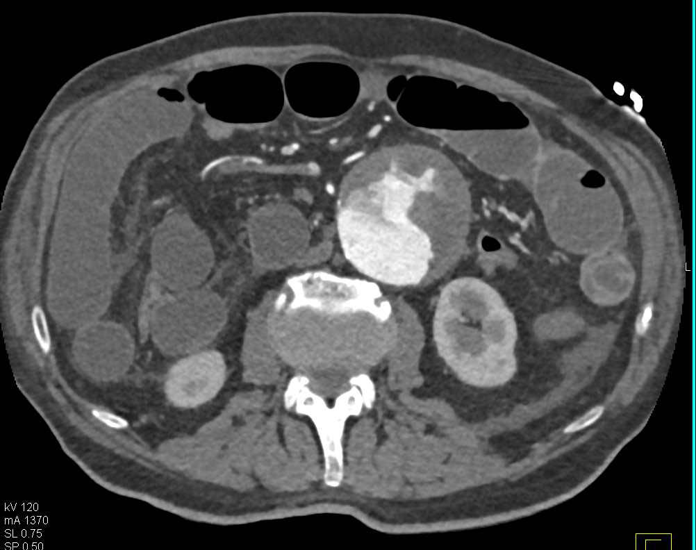 Abdominal Aortic Aneurysm with Turbulent Flow - CTisus CT Scan