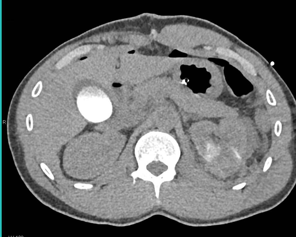 Laceration Left Kidney with Perirenal Blood - CTisus CT Scan