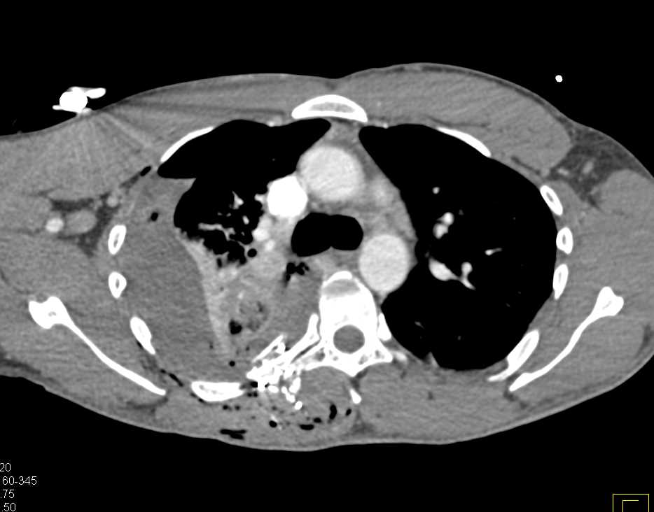 GSW to Chest with Pulmonary Injury and Rib Fractures - CTisus CT Scan