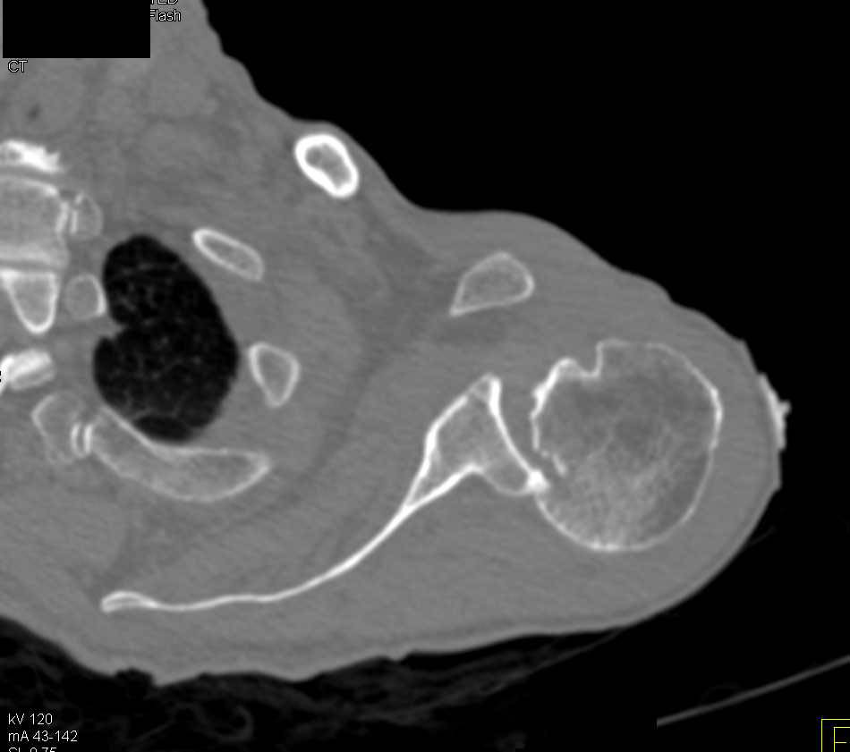 Fracture/Dislocation Left Shoulder - CTisus CT Scan