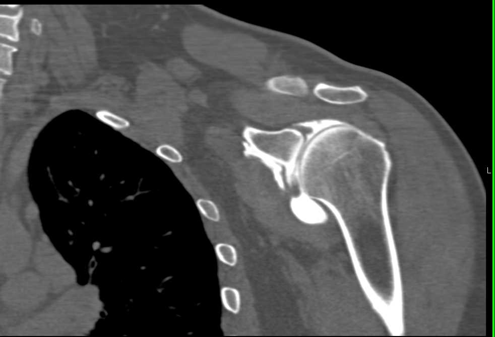 CT Shoulder Arthrogram with Tear - CTisus CT Scan