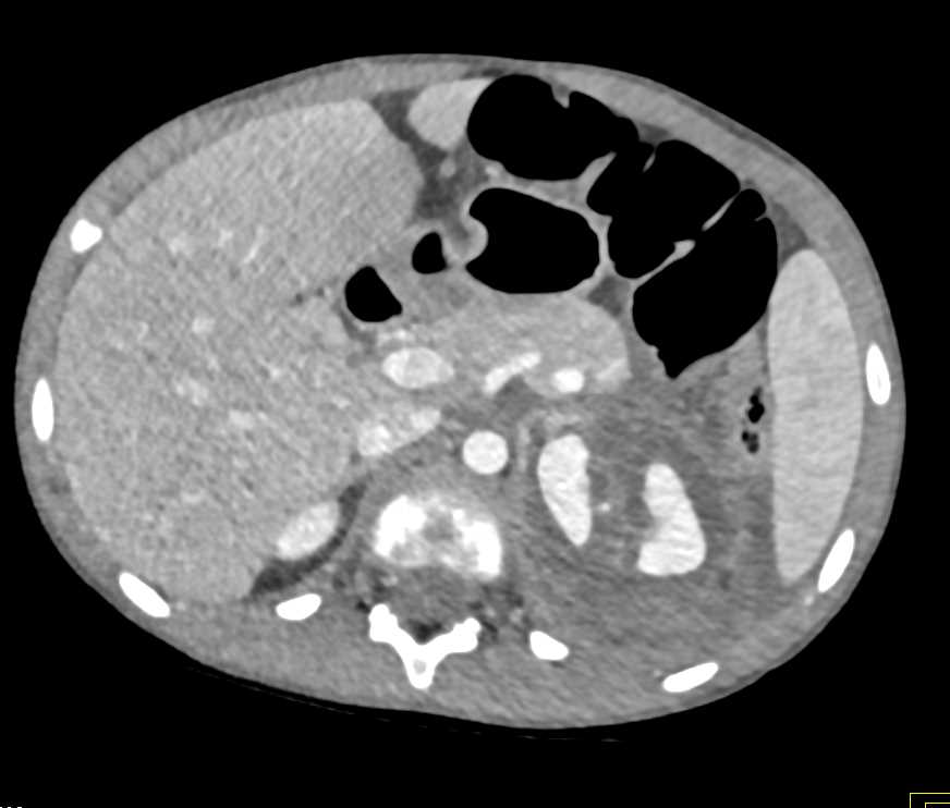 Laceration Left Kidney Post Trauma - CTisus CT Scan