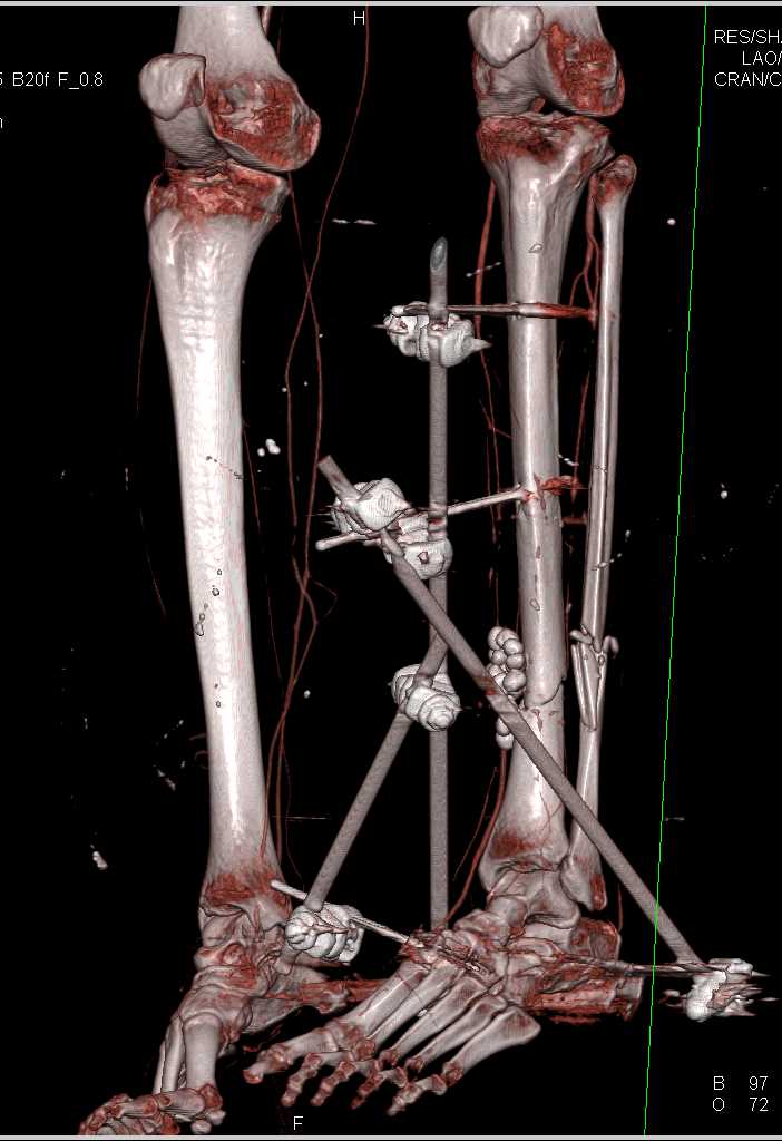 Tibia and Fibular Fractures with Open Reduction Internal Fixation (ORIF) - CTisus CT Scan