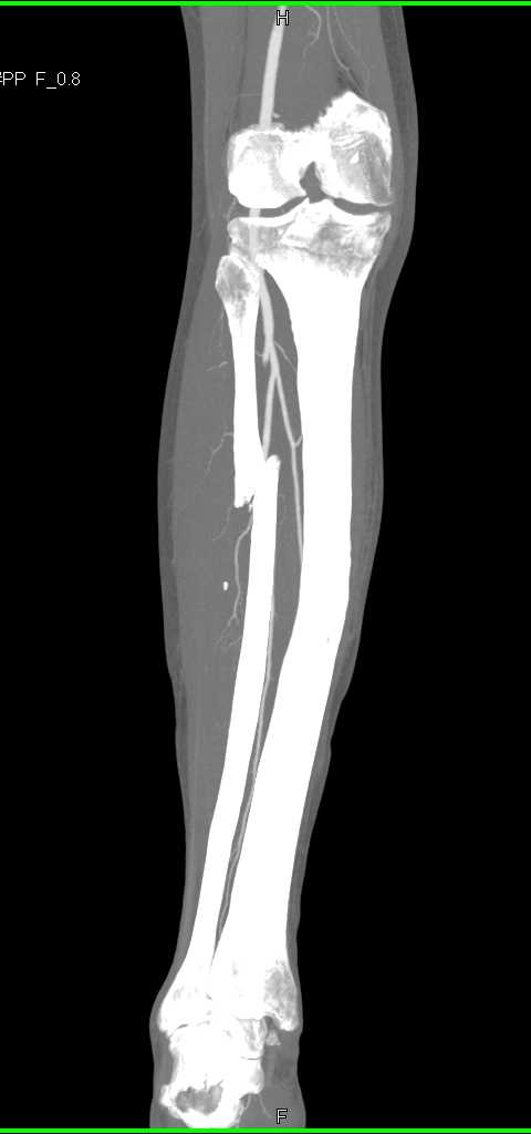 Fibular Fracture Without Vascular Injury - CTisus CT Scan