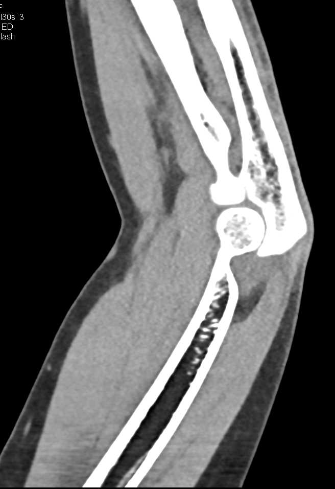 Positive Fat Pad Sign Elbow Following Trauma - CTisus CT Scan