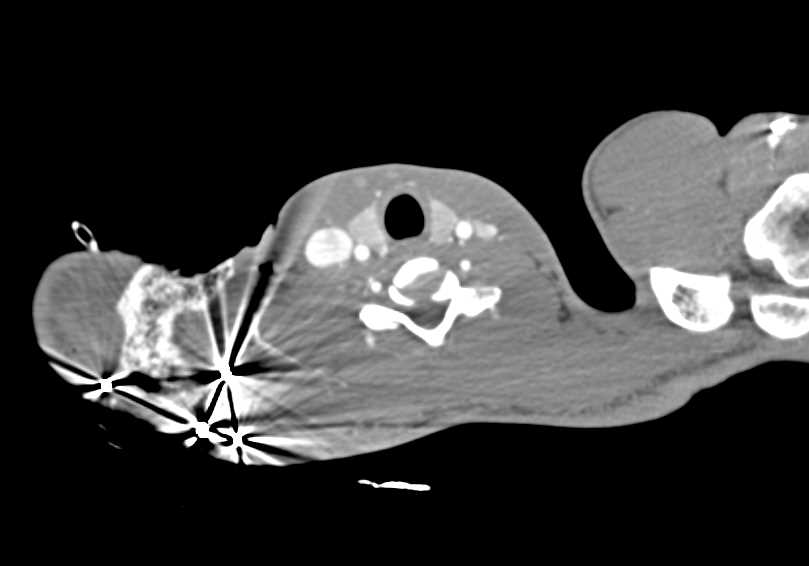 GSW Shoulder Without Vascular Injury - CTisus CT Scan