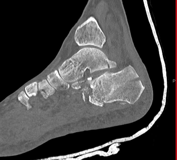 Comminuted Fractures of the Talus and Calcaneus - CTisus CT Scan