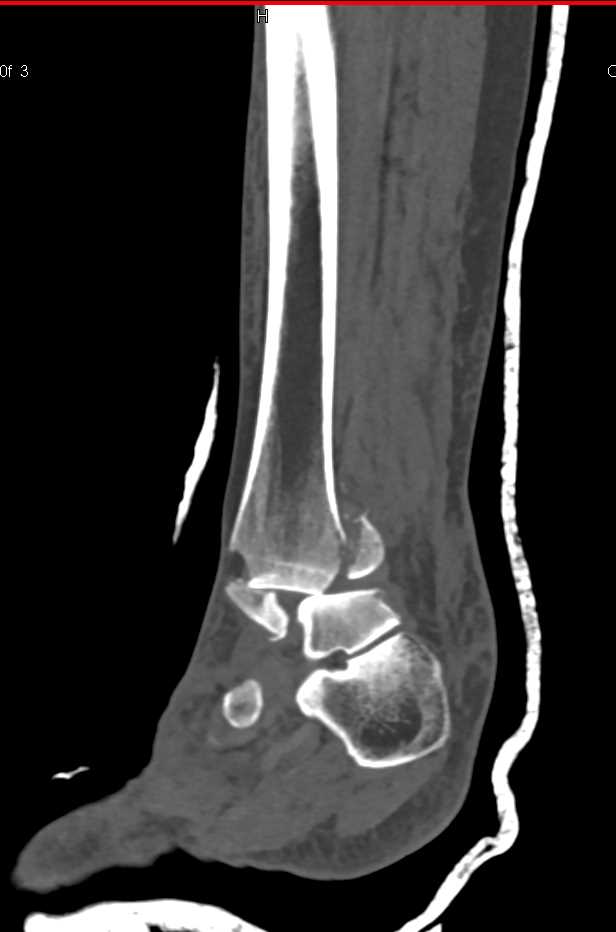 Talus Fracture Dislocation - Trauma Case Studies - CTisus CT Scanning