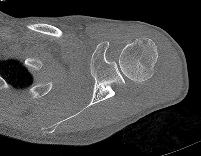 Inferior Glenoid Fracture Post Dislocation and Relocation of Humerus - CTisus CT Scan