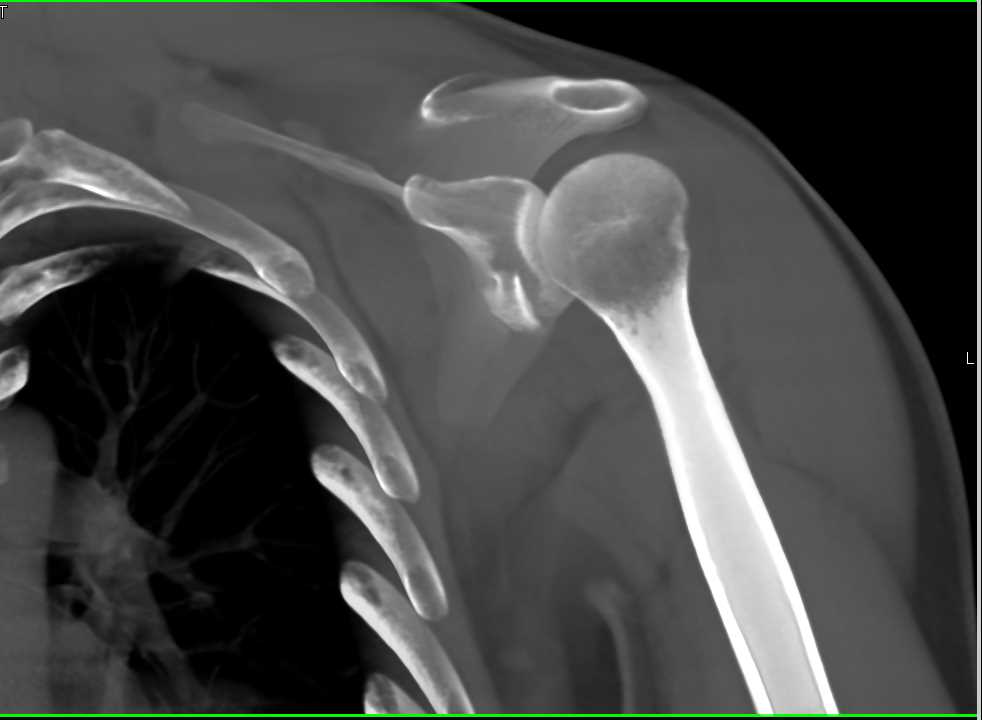 Inferior Glenoid Fracture Post Dislocation and Relocation of Humerus ...