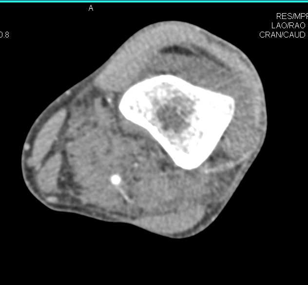 Tibial Plateau Fracture with Lipohemarthrosis and Patent Vessels - CTisus CT Scan