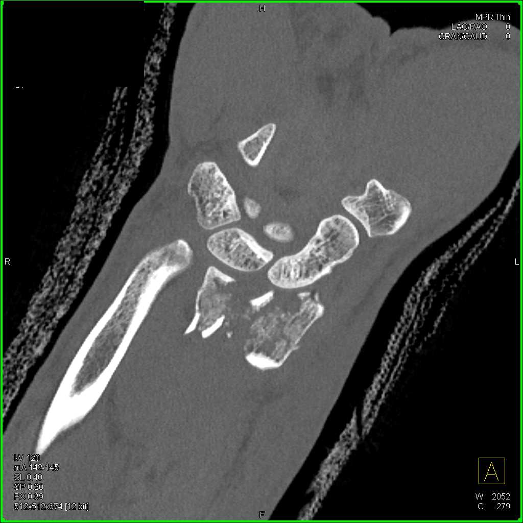 Fracture Distal Radius and Ulna - CTisus CT Scan