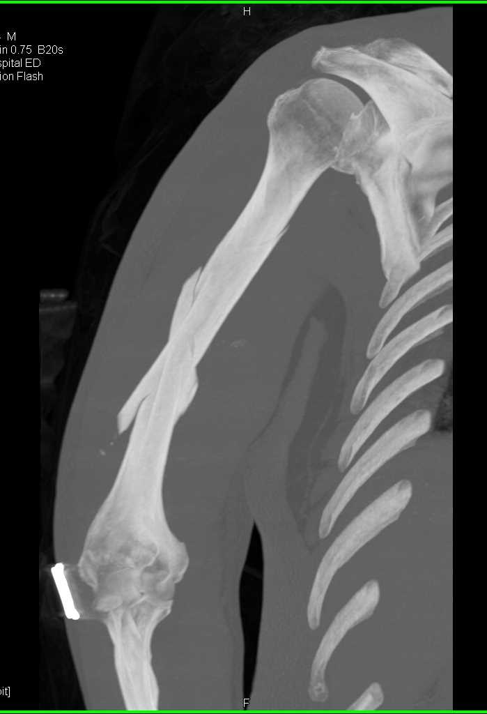 Humerus Fracture - CTisus CT Scan