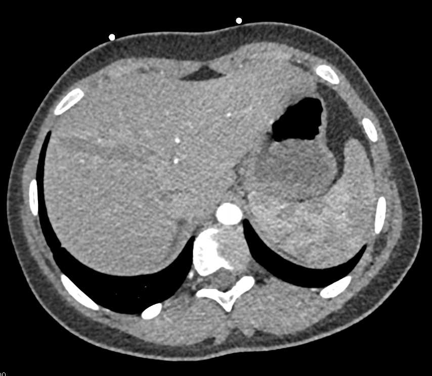 Hepatic Laceration s/p Motor Vehicle Accident (MVA) - CTisus CT Scan