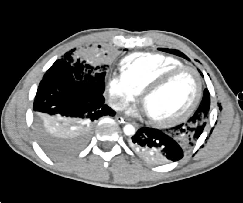 Whole Body Scanning for Pan-Trauma Evaluation - CTisus CT Scan