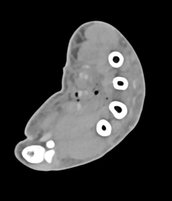 Carpal Fractures Post Trauma - CTisus CT Scan