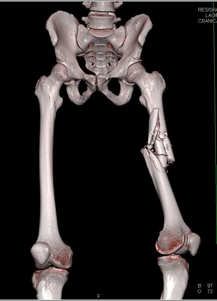 Gunshot Wound (GSW) Left Thigh with Femur Fracture and No Vascular Injury - CTisus CT Scan