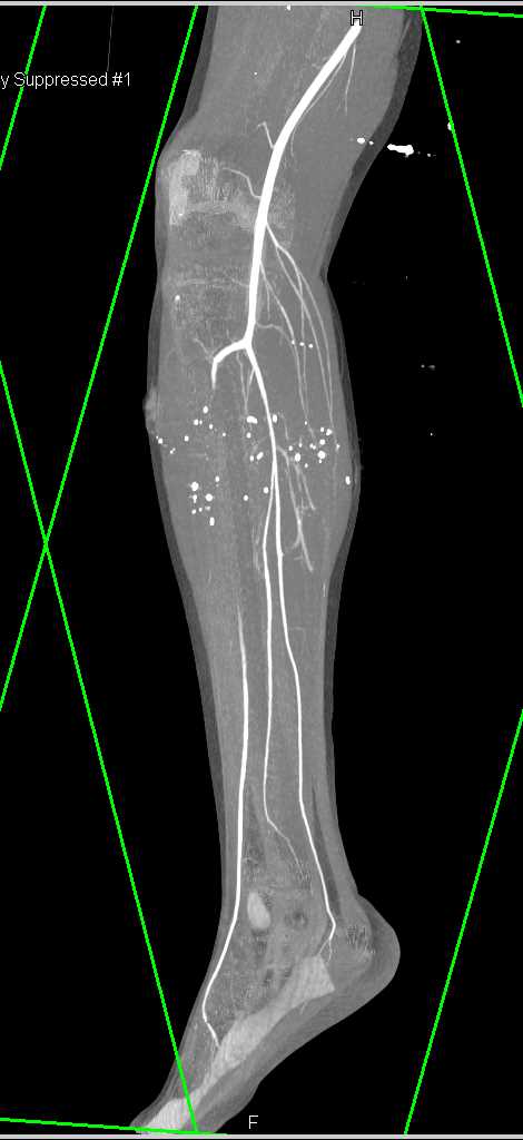 Gunshot Wound (GSW) Calf with Occlusion of the Anterior Tibial Artery - CTisus CT Scan