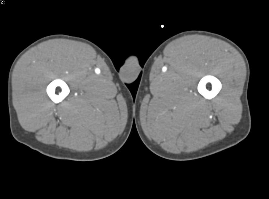 Fracture Distal Right Tibia and Fibula with Vascular Spasm - CTisus CT Scan