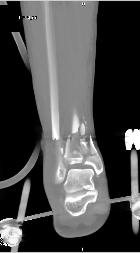 distal tibia fibula fracture