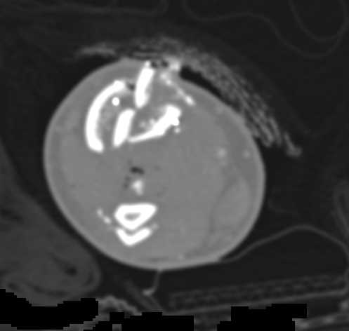 Open Tibia/Fibular Fracture with Vascular Injury to Posterior Tibial Artery - CTisus CT Scan