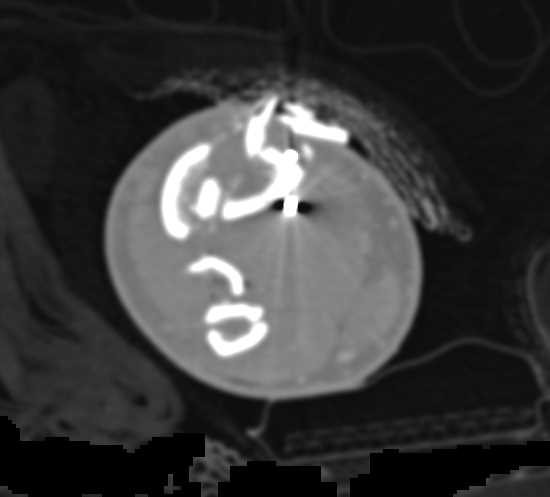 Open Tibia/Fibular Fracture with Vascular Injury to Posterior Tibial Artery - CTisus CT Scan