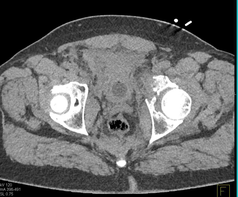 Complex Pelvic Fractures including the Left Acetabulum - CTisus CT Scan