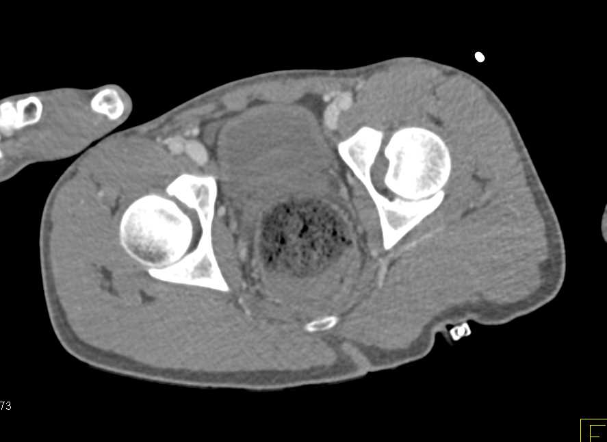 Gunshot Wound (GSW) Perineum Without Vascular Injury - CTisus CT Scan